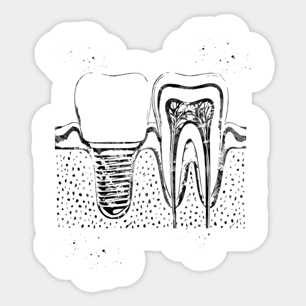 Human teeth and dental implant Sticker by erzebeth